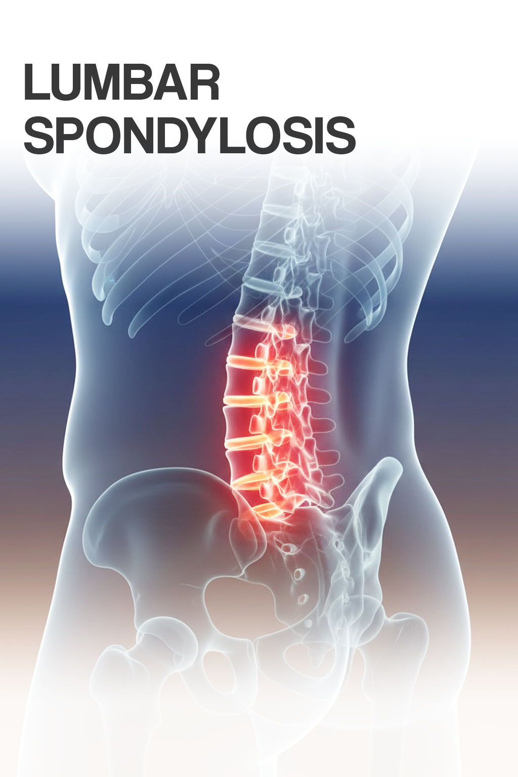 Lumbar Spondylosis